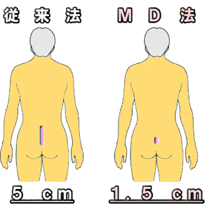 MD法切開図