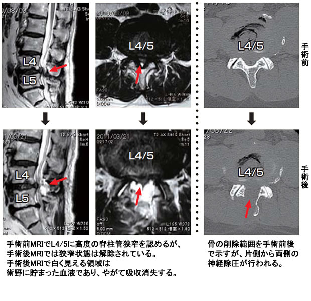 狭窄 腰椎 脊柱 症 管