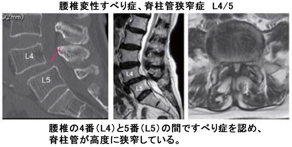 すべり 症 頚椎