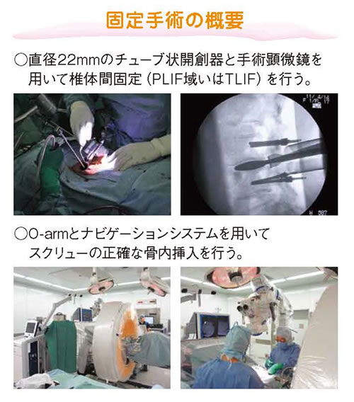 腰椎すべり症に対するmini-open固定術02