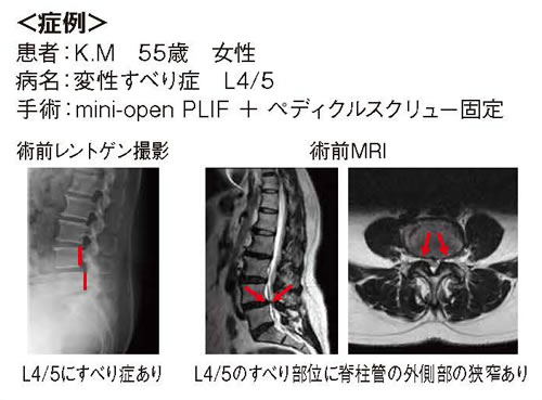 症 腰椎 すべり