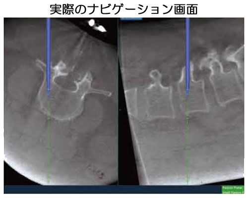 腰椎すべり症に対するmini-open固定術05