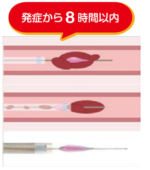 機械的血栓除去術