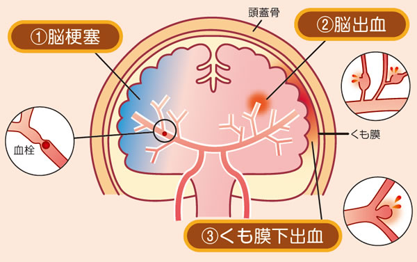 脳卒中分類