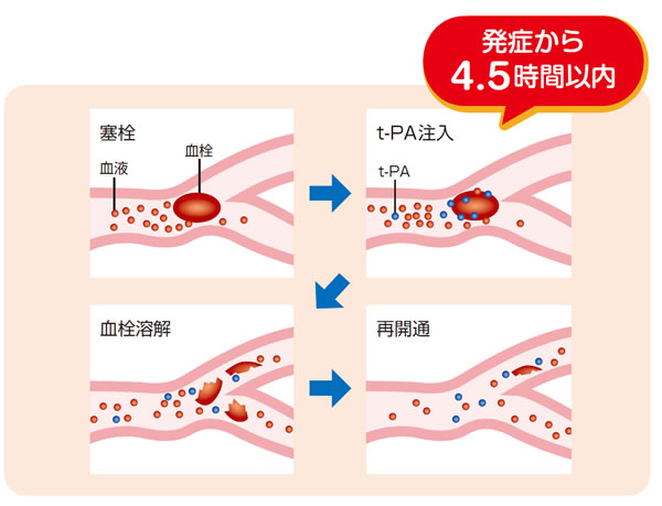 脳梗塞 超急性期の薬物療法