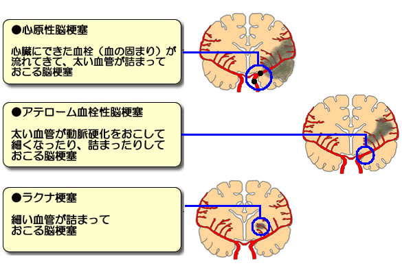 アテローム 血栓 性 脳 梗塞