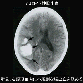 アミロイド・アンギオパシーによる脳出血