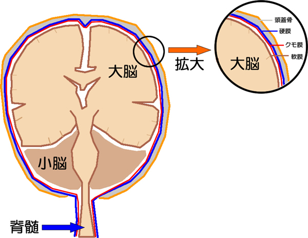 寿命 出血 予後 くも膜 下