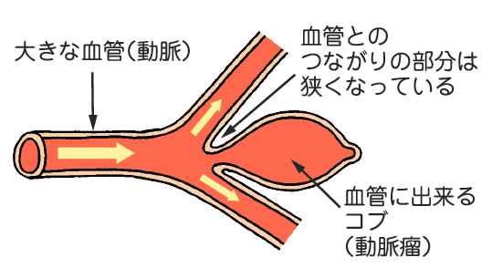 くも膜下出血動脈瘤図01