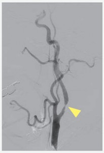 CAS（経皮的頚動脈ステント留置術）イメージ03