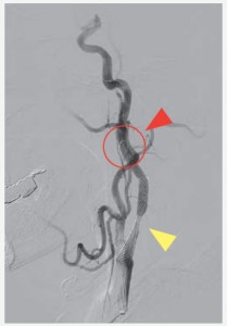 CAS（経皮的頚動脈ステント留置術）イメージ04