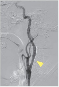 CAS（経皮的頚動脈ステント留置術）イメージ05