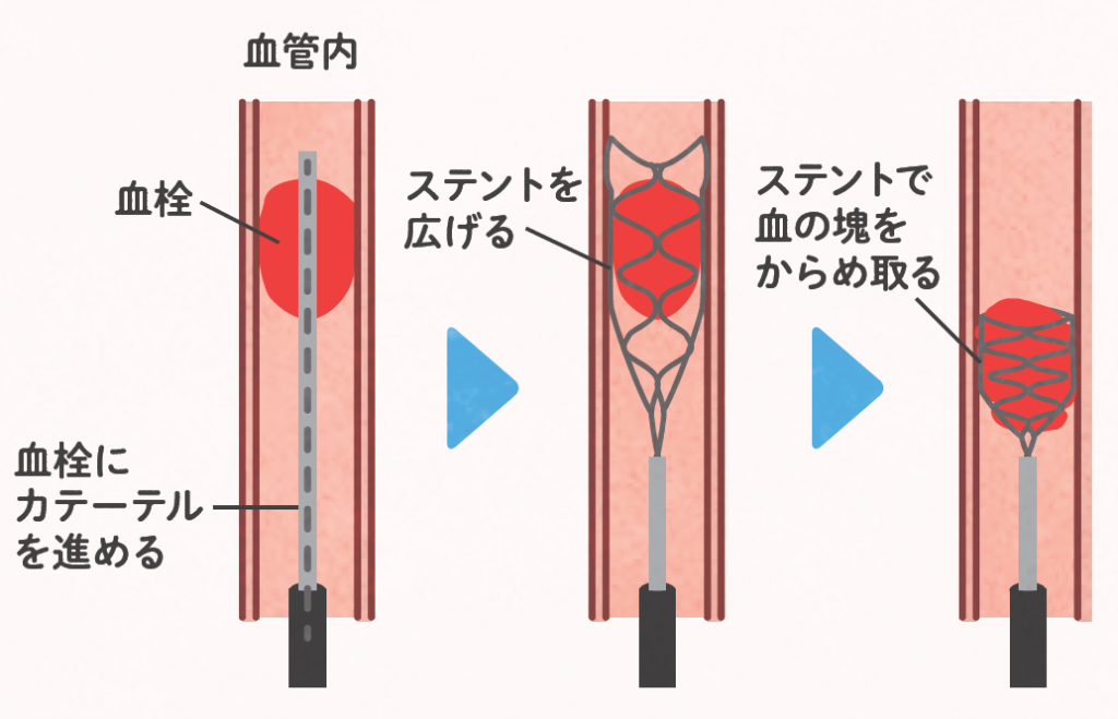 血管形成術とステント留置術はどのように行われますか?